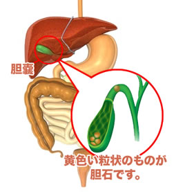 胆石の図解